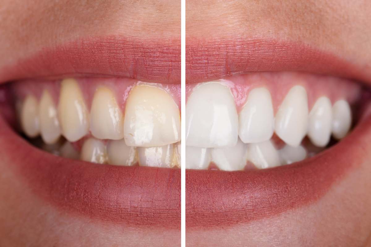 https://drshrutibhamare.in/assets/media/Teeth-Whitening.jpg